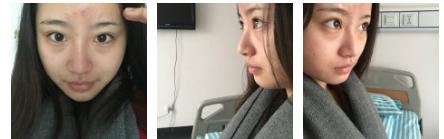 超 声 波去眼袋让你得青春不吃眼袋得亏 超 声 波去眼袋让你得青春不吃眼袋得亏