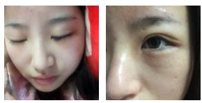 超 声 波去眼袋让你得青春不吃眼袋得亏 超 声 波去眼袋让你得青春不吃眼袋得亏