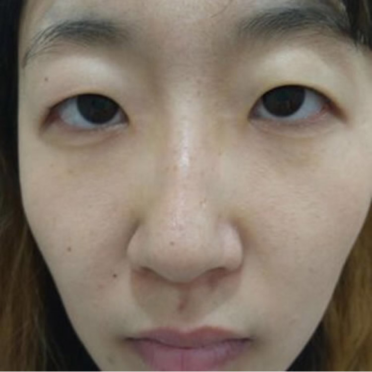 旅行的路上我收获了超声波双眼皮685 旅行的路上我收获了超声波双眼皮685