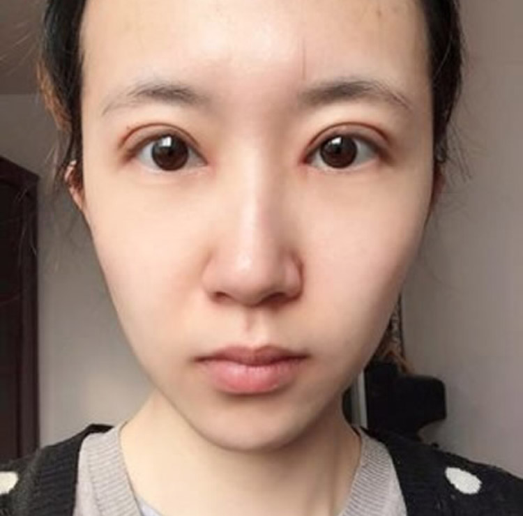 旅行的路上我收获了超声波双眼皮685 旅行的路上我收获了超声波双眼皮685