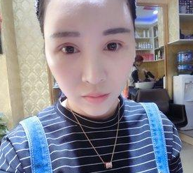 眼睛基础不是很好,但是超声波双眼皮后很漂亮488 眼睛基础不是很好,但是超声波双眼皮后很漂亮488