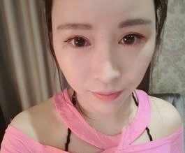眼睛基础不是很好,但是超声波双眼皮后很漂亮488 眼睛基础不是很好,但是超声波双眼皮后很漂亮488