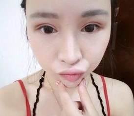 眼睛基础不是很好,但是超声波双眼皮后很漂亮488 眼睛基础不是很好,但是超声波双眼皮后很漂亮488