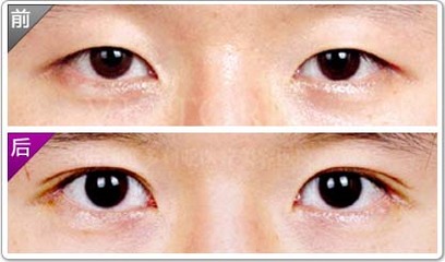 超声波双眼皮让我妈妈梦想成真875 超声波双眼皮让我妈妈梦想成真875