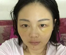 超声波去眼袋4天了,来看看我的效果719 超声波去眼袋4天了,来看看我的效果719