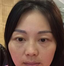 超声波去眼袋4天了,来看看我的效果719 超声波去眼袋4天了,来看看我的效果719