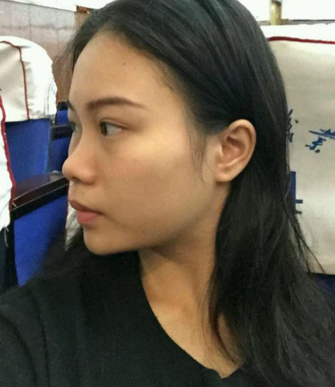 不开刀隆鼻后我的新生活开始了803 不开刀隆鼻后我的新生活开始了803
