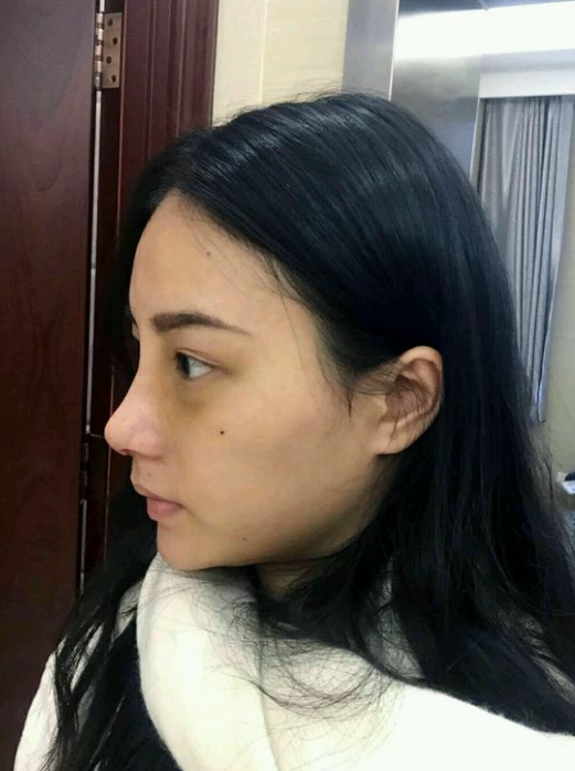 不开刀隆鼻后我的新生活开始了803 不开刀隆鼻后我的新生活开始了803