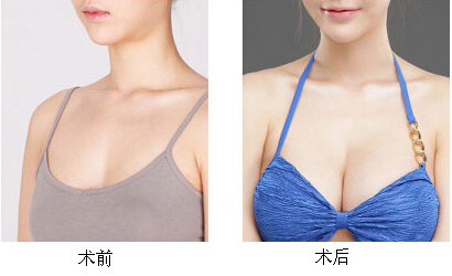 波涛汹涌之超声法自体脂肪隆胸 波涛汹涌之超声法自体脂肪隆胸