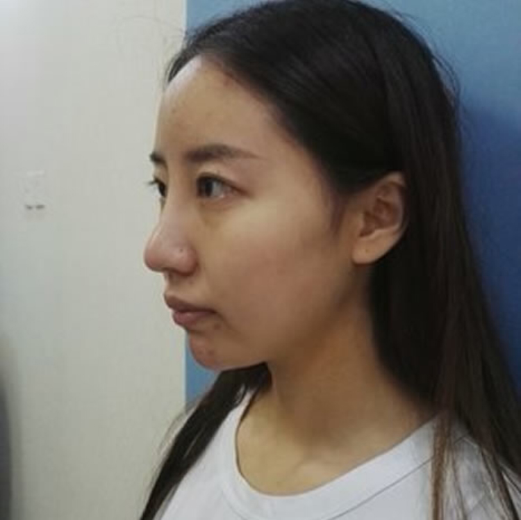 我美丽的双眼皮就是做超声波双眼皮做出来的207 我美丽的双眼皮就是做超声波双眼皮做出来的207