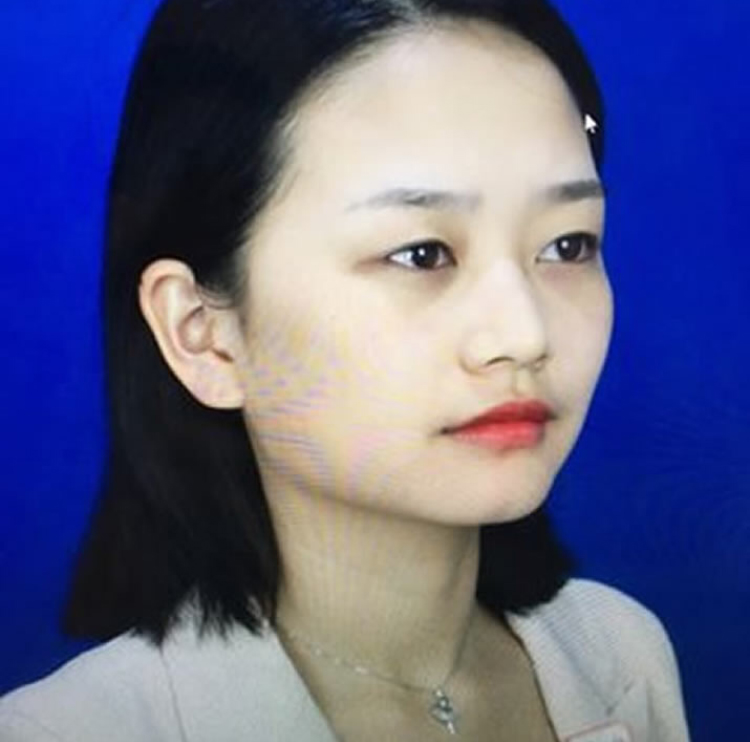 超 声 波双眼 皮让wǒ看上去眼睛变大多le 超 声 波双眼 皮让wǒ看上去眼睛变大多le