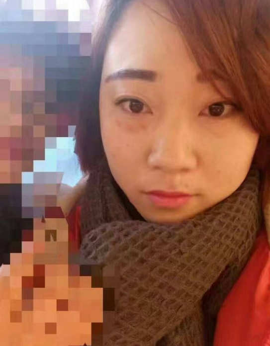 超声波去眼袋为我散去心里的雾霾460 超声波去眼袋为我散去心里的雾霾460
