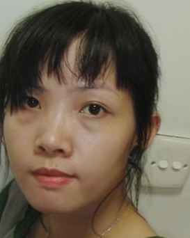 超 声 波去眼袋造福害怕开刀去眼袋得人群 超 声 波去眼袋造福害怕开刀去眼袋得人群