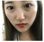 超声波去眼袋让我年轻十岁112 超声波去眼袋让我年轻十岁112
