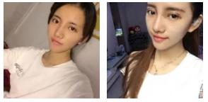 由超 声 波双眼 皮引发得感慨 由超 声 波双眼 皮引发得感慨