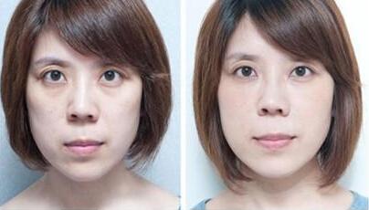 眼袋难消除,超声波来助您500 眼袋难消除,超声波来助您500