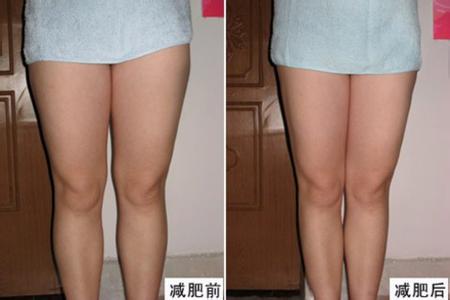 成功减掉大腿肉肉——超声波减肥手术119 成功减掉大腿肉肉——超声波减肥手术119