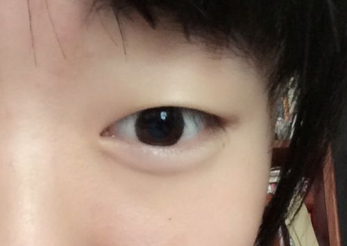 超声波去眼袋的副作用严重吗?效果怎样?793 超声波去眼袋的副作用严重吗?效果怎样?793