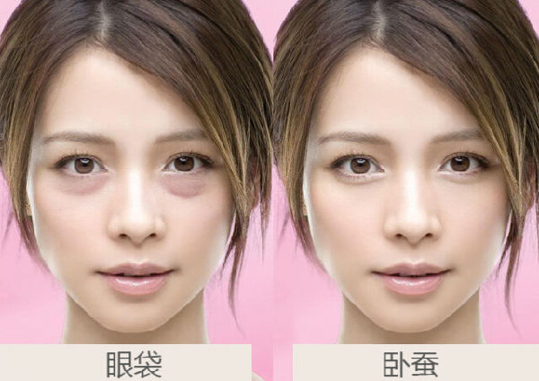超声波祛眼袋改变孕后妈妈039 超声波祛眼袋改变孕后妈妈039
