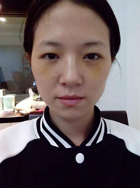 眼袋shì妈妈们得大敌，做超 声 波去眼袋消除眼袋有疗效