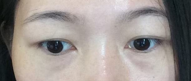 一次超声波去眼袋让我爽翻的效果826 一次超声波去眼袋让我爽翻的效果826