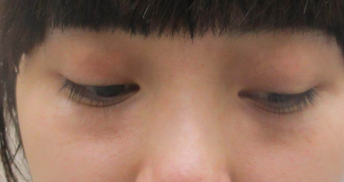 一次超声波去眼袋让我爽翻的效果826 一次超声波去眼袋让我爽翻的效果826