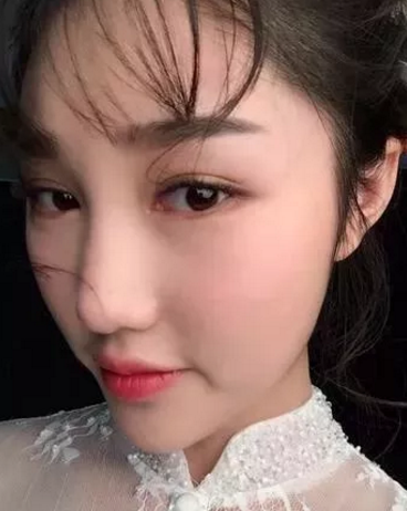 对自己的单眼皮不满意，我就去做了超声波双眼皮197