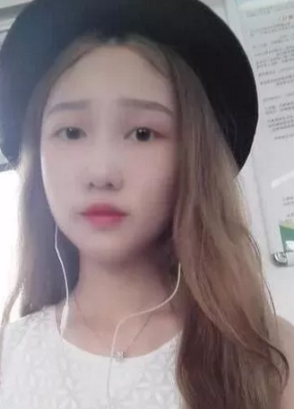 对自己的单眼皮不满意，我就去做了超声波双眼皮197