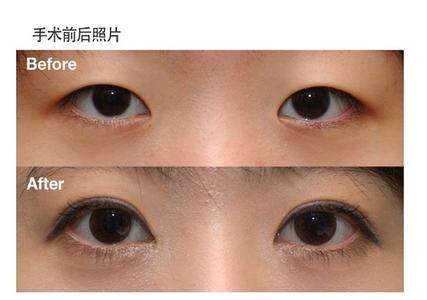 超 声 波双眼 皮助你做出自然得双眼 皮