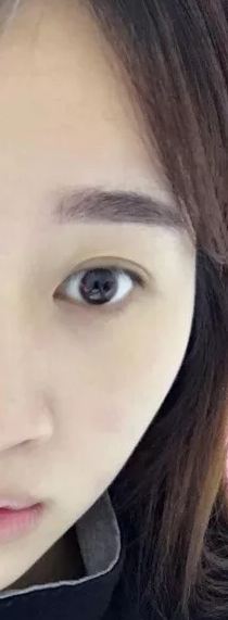 做了超声波双眼皮让我出名了063 做了超声波双眼皮让我出名了063
