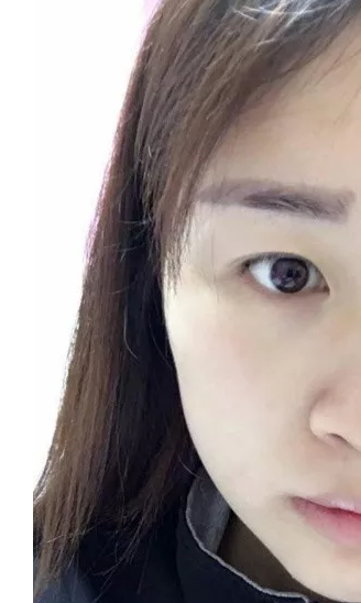 做了超声波双眼皮让我出名了063 做了超声波双眼皮让我出名了063