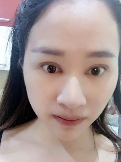 做了超声波双眼皮让我出名了063 做了超声波双眼皮让我出名了063