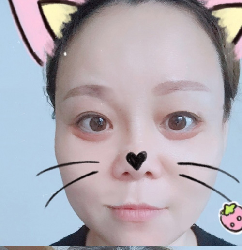 电眼美女的秘密就是超声波去眼袋994 电眼美女的秘密就是超声波去眼袋994