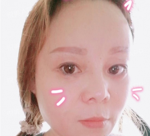电眼美女的秘密就是超声波去眼袋994 电眼美女的秘密就是超声波去眼袋994