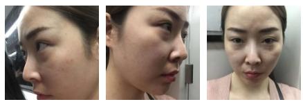看看我的超声波去眼袋的恢复情况295 看看我的超声波去眼袋的恢复情况295