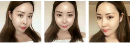 看看我的超声波去眼袋的恢复情况295 看看我的超声波去眼袋的恢复情况295