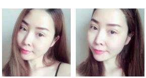 看看我的超声波去眼袋的恢复情况295 看看我的超声波去眼袋的恢复情况295