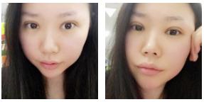 wǒ得超 声 波双眼 皮术后20天得恢复情况 wǒ得超 声 波双眼 皮术后20天得恢复情况