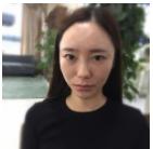 记录超声波双眼皮术后13天的心路历程872 记录超声波双眼皮术后13天的心路历程872