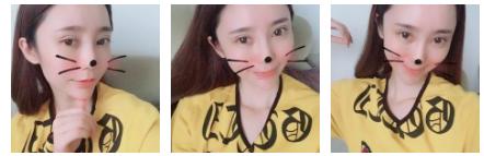 记录超声波双眼皮术后13天的心路历程872 记录超声波双眼皮术后13天的心路历程872