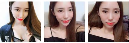 记录超声波双眼皮术后13天的心路历程872 记录超声波双眼皮术后13天的心路历程872