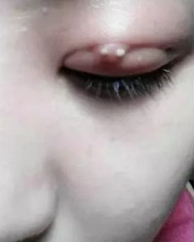 超 声 波双眼 皮助你明眸翘睫 超 声 波双眼 皮助你明眸翘睫