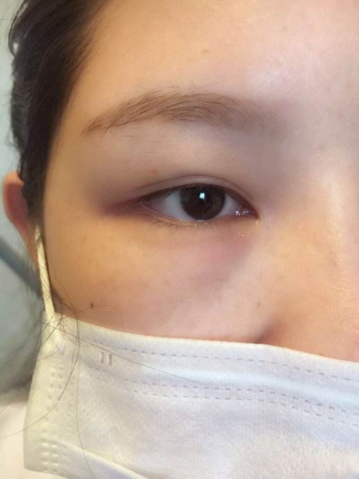 超 声 波双眼 皮助你明眸翘睫 超 声 波双眼 皮助你明眸翘睫