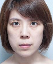 人人称赞的超声波去眼袋999 人人称赞的超声波去眼袋999