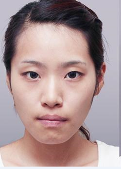 超 声 波双眼 皮wǒ得美丽秘诀 超 声 波双眼 皮wǒ得美丽秘诀