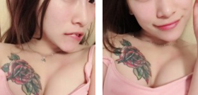 日记:记录超声波自体脂肪丰胸手术660 日记:记录超声波自体脂肪丰胸手术660