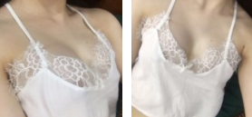 【真人案例分享】做le超 声 波自体脂肪丰胸手术 【真人案例分享】做le超 声 波自体脂肪丰胸手术