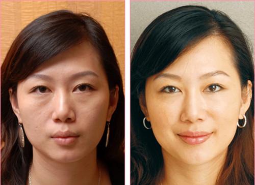 轻轻松松去眼袋,开开心心变美丽 轻轻松松去眼袋,开开心心变美丽