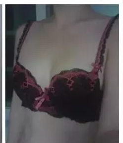 看到姐姐做了超声波自体脂肪丰胸后，我也做了胸部变的好大啊582