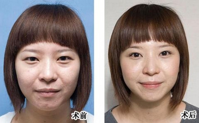 超声波祛眼袋,让你从此变美丽577 超声波祛眼袋,让你从此变美丽577